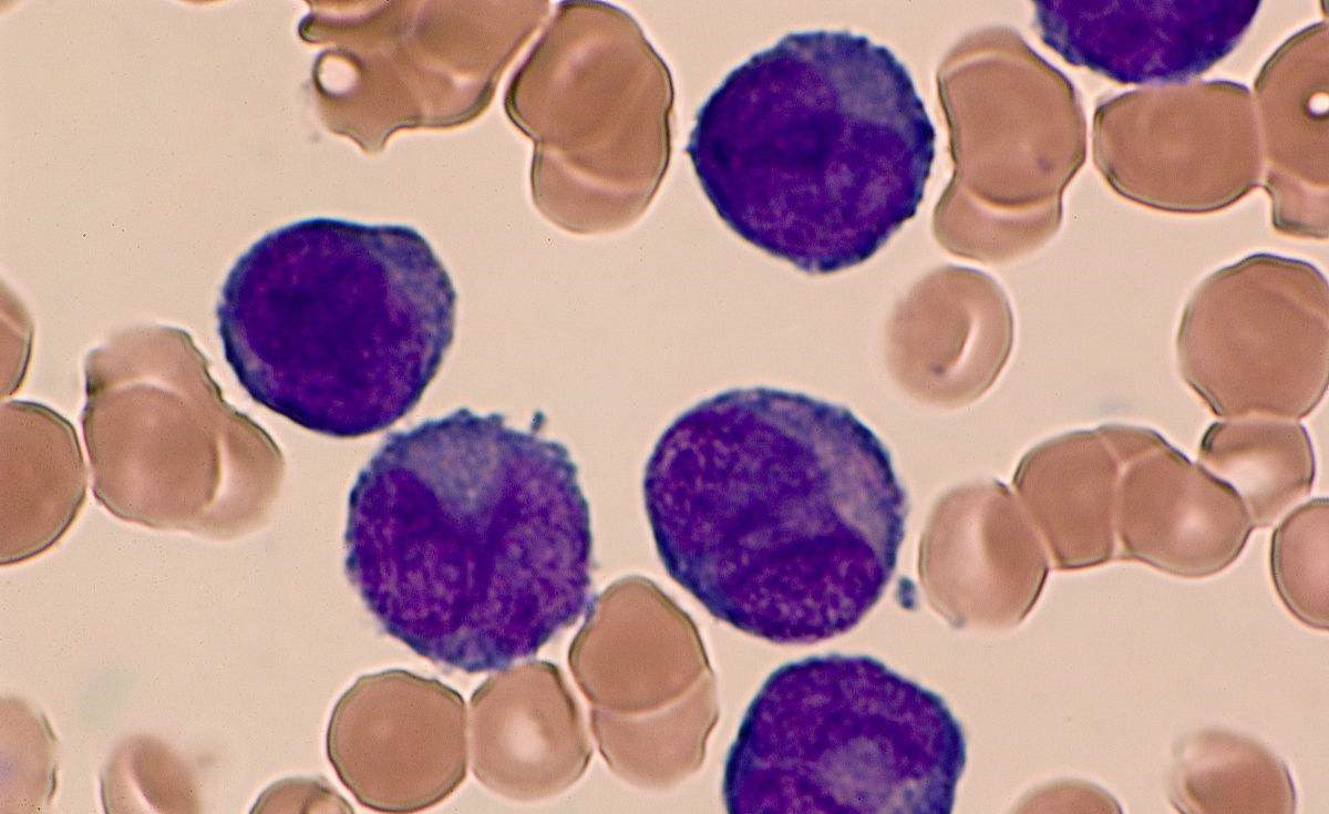 家庭裝修是導(dǎo)致白血病的***因素！家里甲醛超標(biāo)怎么辦