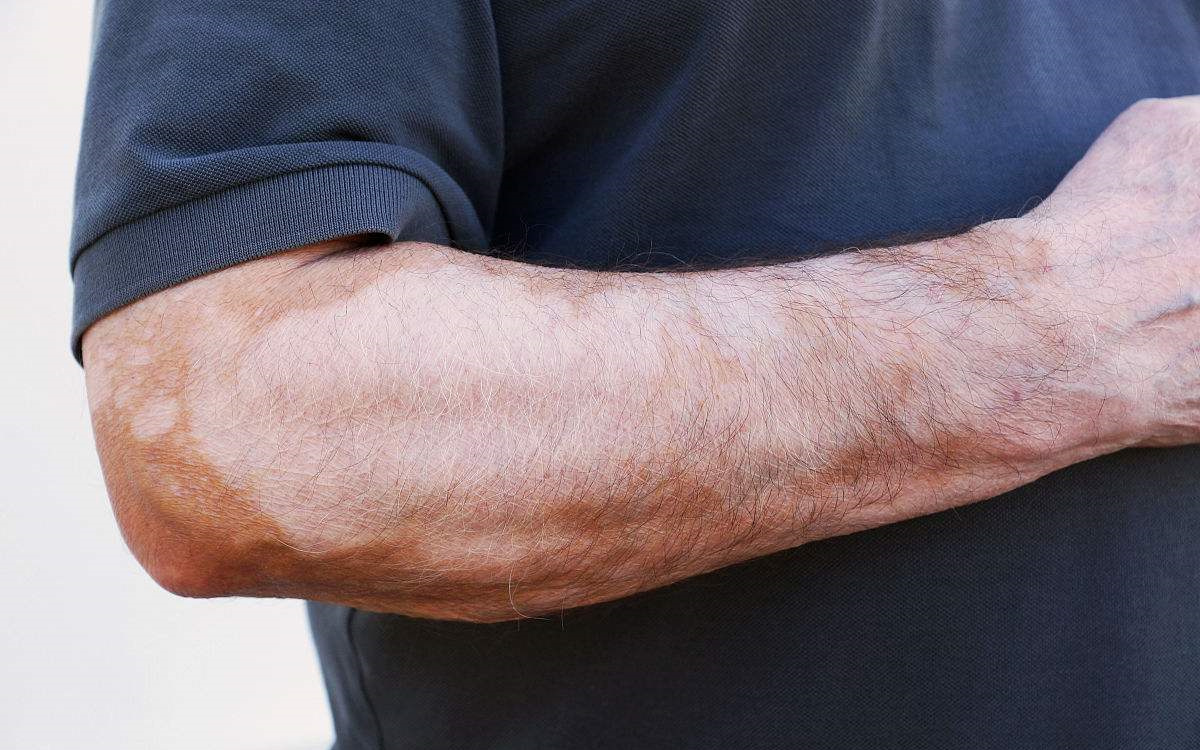 甲醛超標(biāo)和白癜風(fēng)有關(guān)系嗎？裝修污染對(duì)人體影響極大！