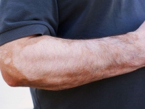 甲醛超標(biāo)和白癜風(fēng)有關(guān)系嗎？裝修污染對人體影響極大！